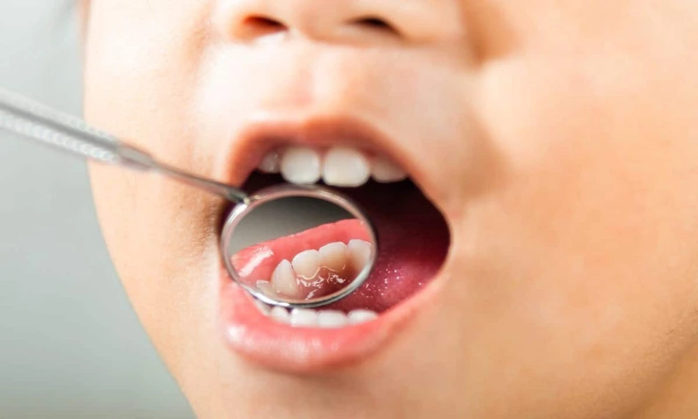 How Pediatric Dentists Treat Irritated Gum Tissue Around New Back Teeth